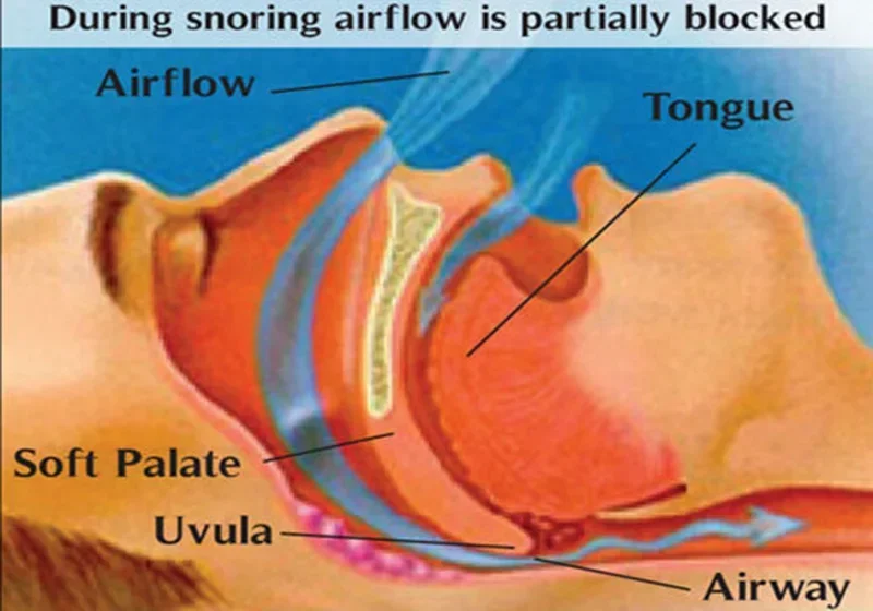 Clip nasal antironquidos para respirar, fácil sueño, ayuda antironquidos, dispositivo dilatador Nasal, ayuda para la congestión, sin tiras, conos, 2