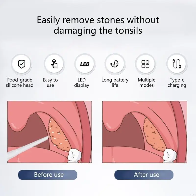 Tonsil Stone Suction Tool Featuring 3 Soft Probes 3 Suction Intensities N58D