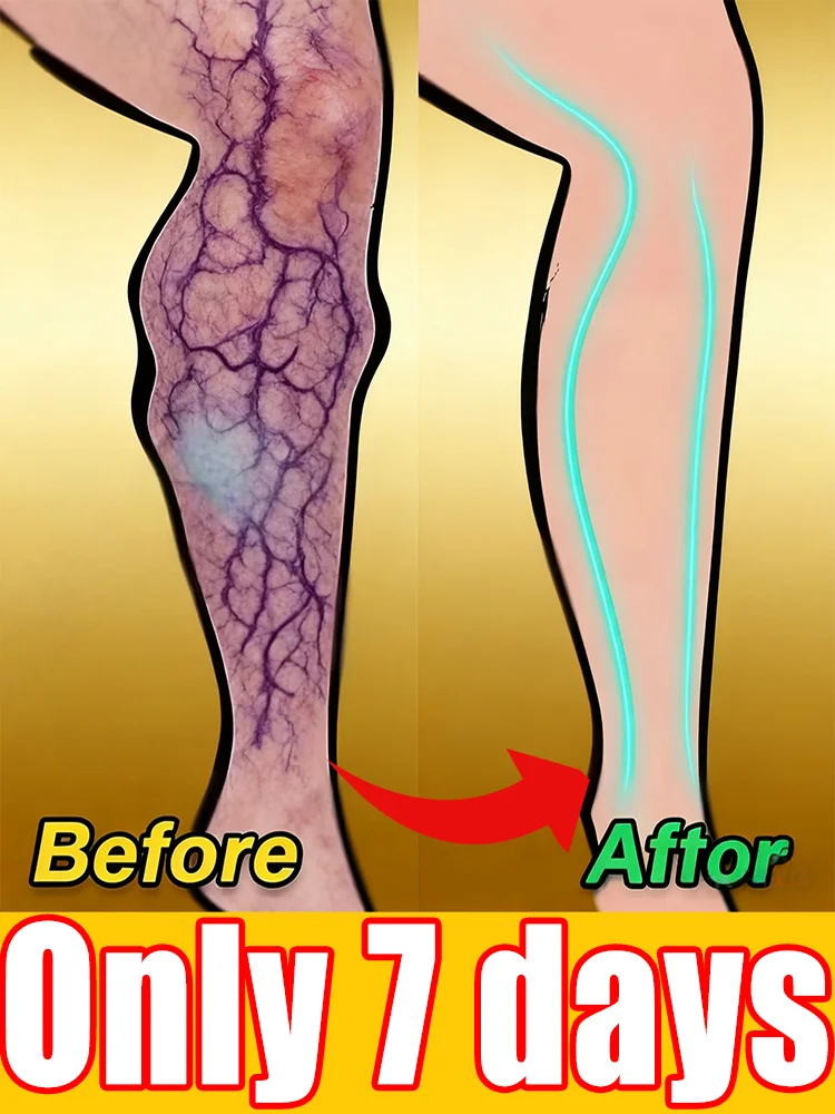 

Wᴇᴀʀ Sʜᴏʀᴛs Wɪᴛʜ Cᴏɴғɪᴅᴇɴᴄᴇ: Vᴀʀɪᴄᴏsᴇ Cʀᴇᴀᴍ Tʜᴀᴛ Sᴜᴘᴘᴏʀᴛs Yᴏᴜʀ Vᴇɪɴs