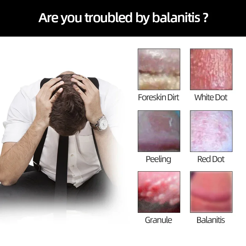 Balanitis Cream Apply To Pearl Rash Itching Bacterial Infection Cure CFDA Approval 20g/boxs Glans Treatment Medicine Spray