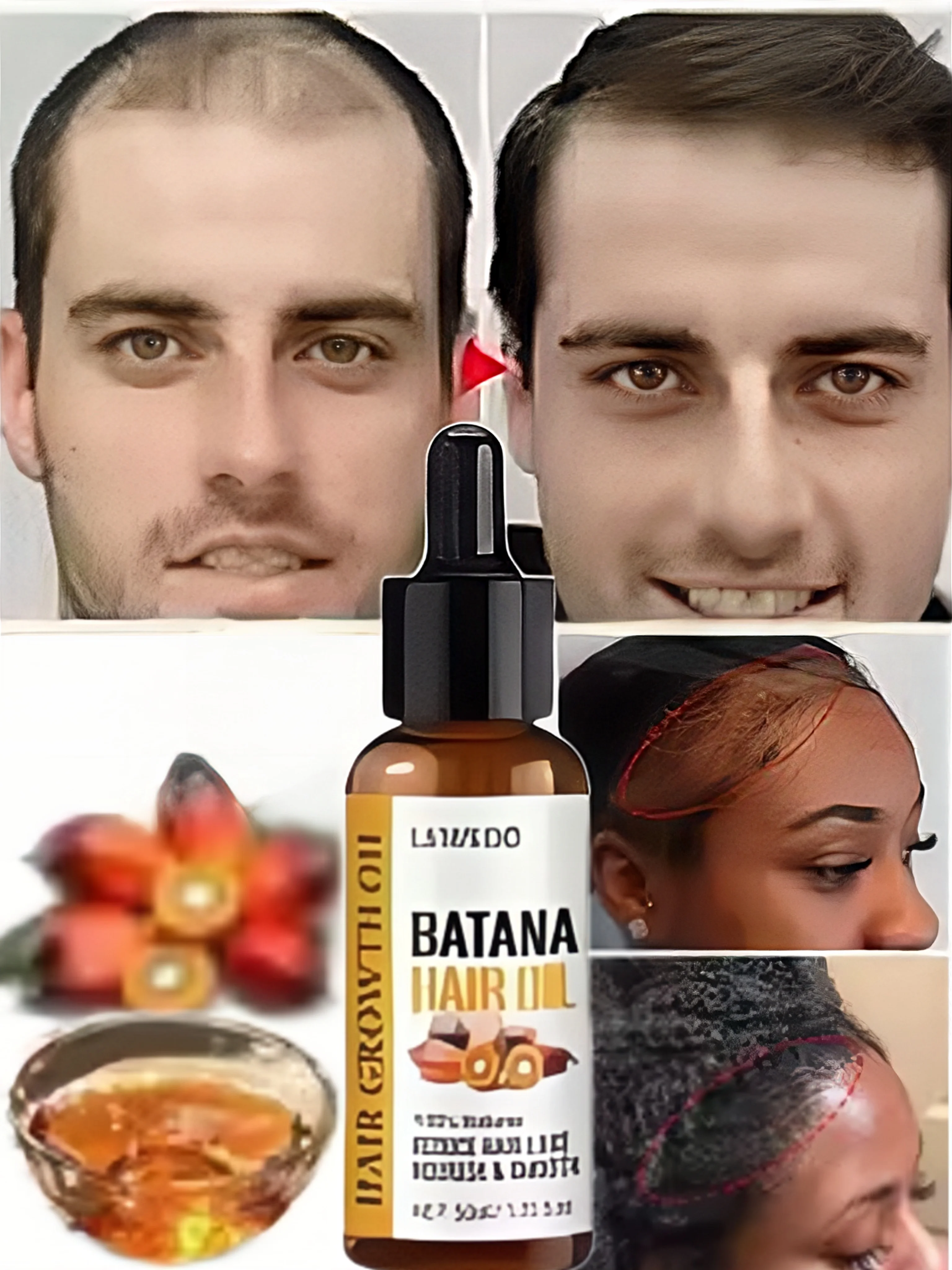 زيت باتانا لنمو الشعر السريع للرجال والنساء، شعر لامع مغذي، العناية الصحية بالشعر، مصل مضاد لتساقط الشعر، إصلاح طبيعي للسد #1