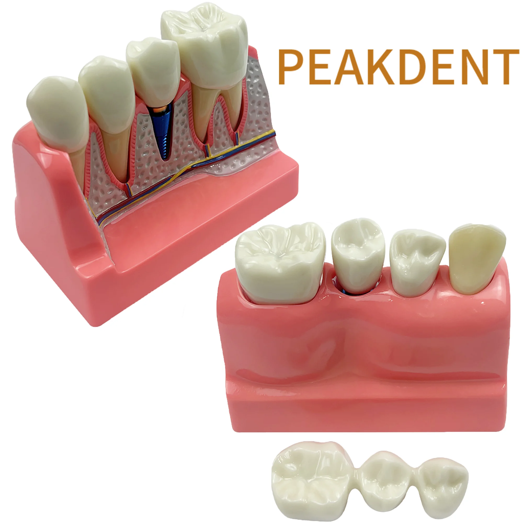 4 Times Implant Model Dental Bridges Crown Dental Teaching Model With Removable Demonstration Tools For Dentist Student Teach