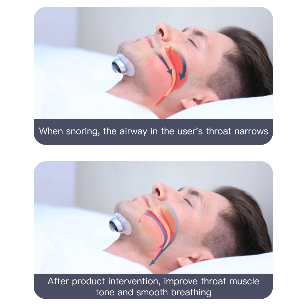 YA4200  Smart Snore Device  Effectively Reduces Snoring By Correcting Breathing Pauses And Nasal Snoring.