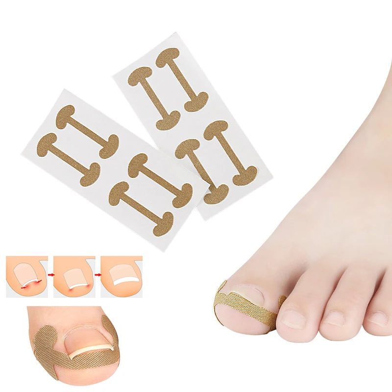 Ingrown Toenail Corrector Patches Nail Correction Stickers for Paronychia Treatment Pedicure Care Tool for Recovering Nails