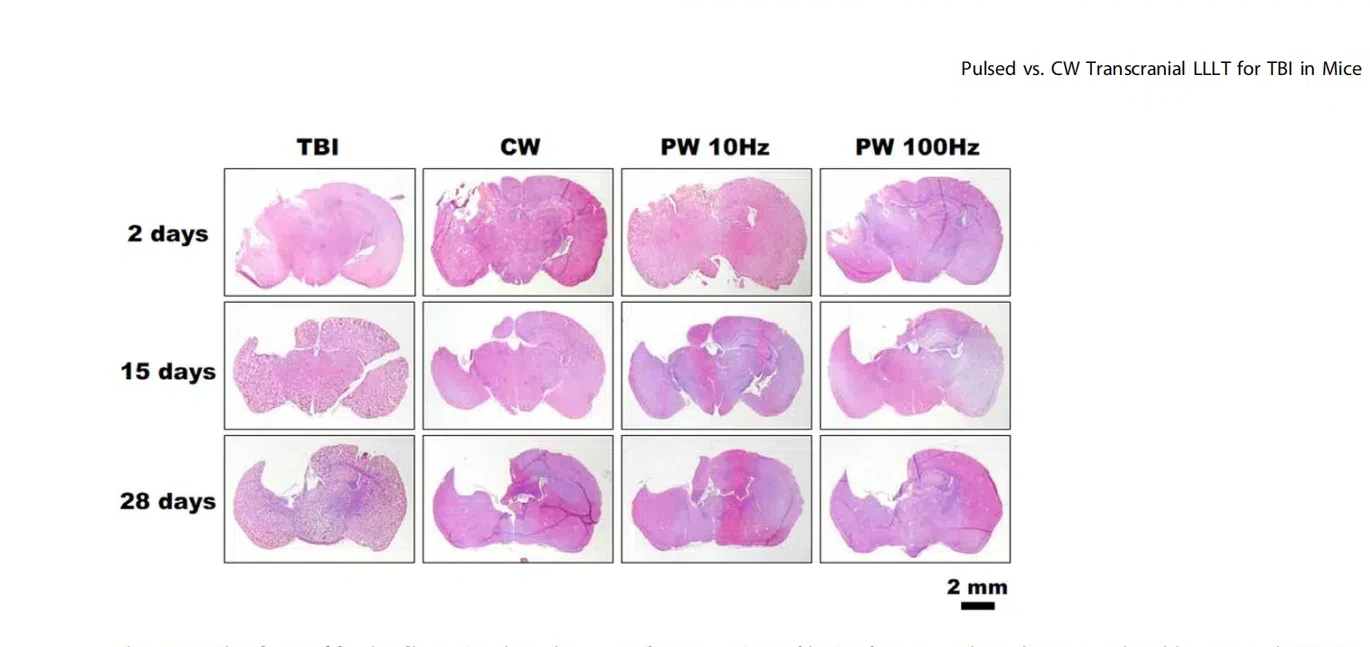 Medizinische Neuronenstimulation 810nm PBM Helm zur Rehabilitation bei Gehirnerkrankungen, Traumatischen Hirnschäden, PTBS, Alzheimer und Schlaganfall – Detail 5