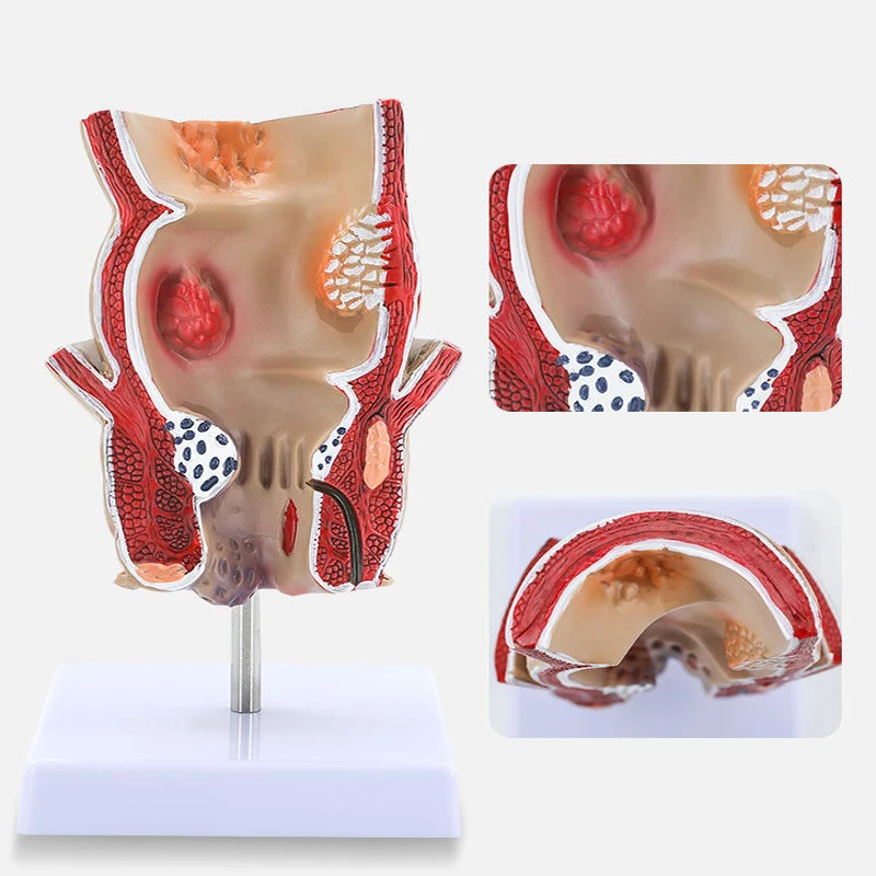 Anatomical Model Human Rectum Pathological Lesion Model Hemorrhoids Anatomy Medical Teaching Supplies Tools