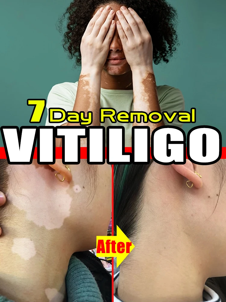 

Vitiligo Ointment Effectively Suppresses Spot Enlargement