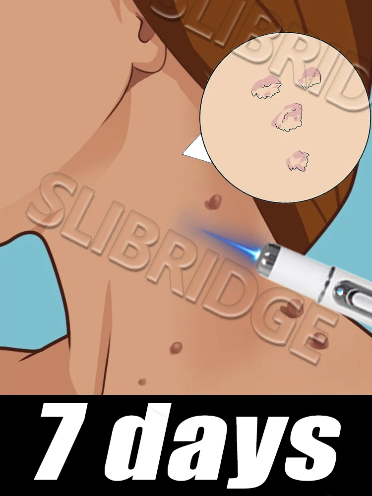 

blue light pen to solve body warts, wart care tools,unisex, suitable for all ages,promotional discount,Free shipping