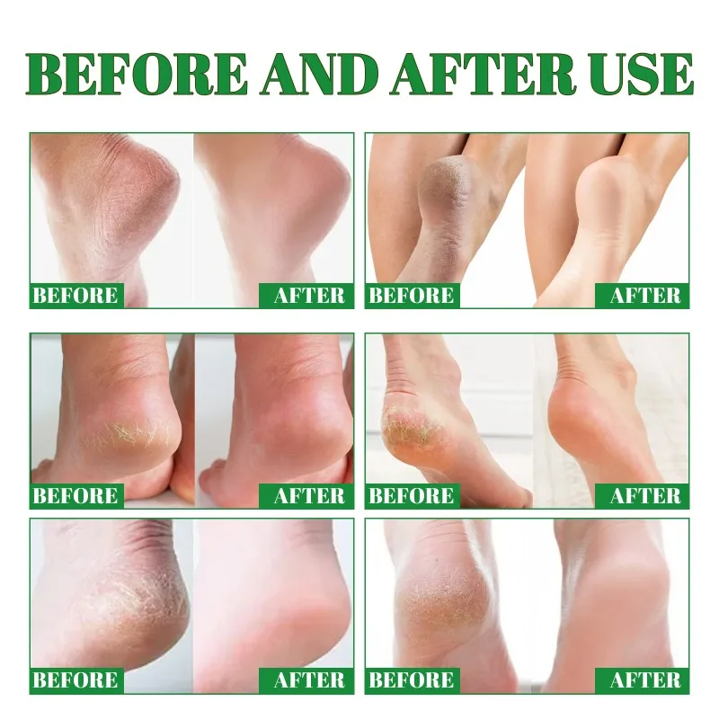 Anti Crack Foot Cream Heel Cracked Repair remove exfoliation Removal Dead Skin Callus Anti-Drying  peeling Hand Feet Skin Care