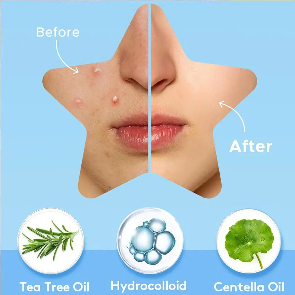 Star Acne Patch Blackheads And Closed Comedones Improve Acne Skin Hydrocolloid Acne Beauty Tools Women Cosmetic