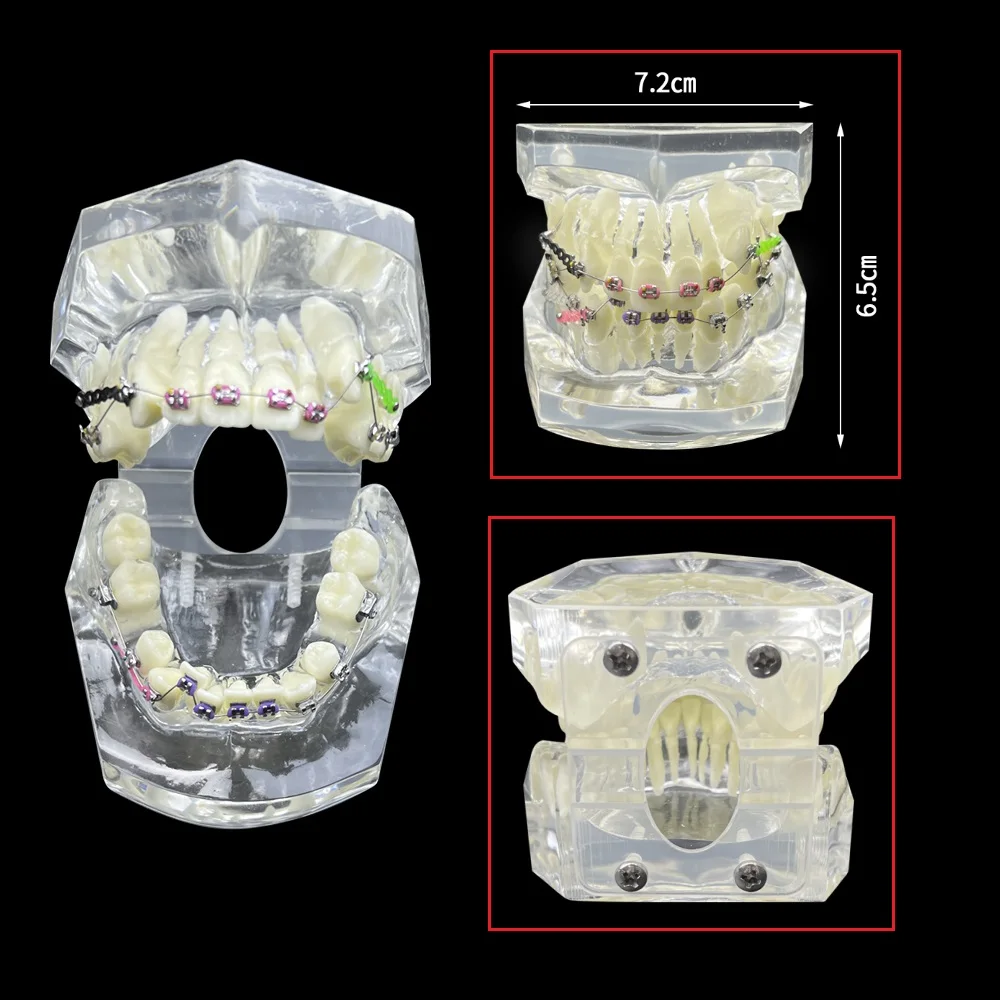 Dental Orthodontic Teeth Model Metal Brackets Arch‑Wire Ligature Tie Typodont Model for Ortho Patient Education Demonstration