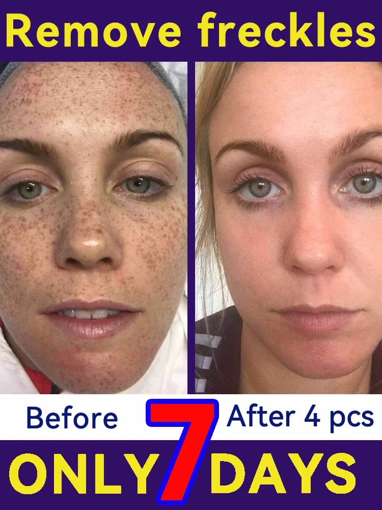 

An effective facial freckle cream that removes freckles and solves the freckle problem that has existed for many years