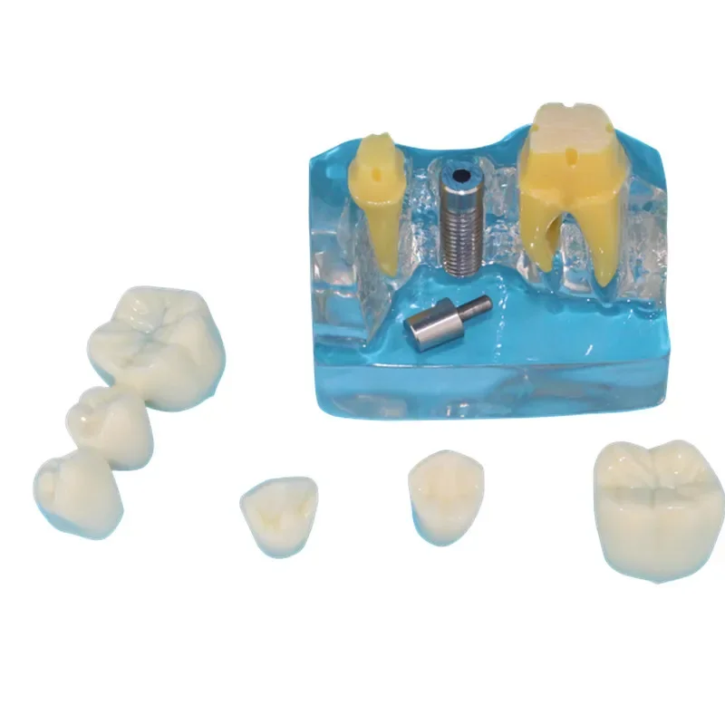 Model Gigi Mulut Manusia, Model Gigi Transparan, Model Implan Gigi