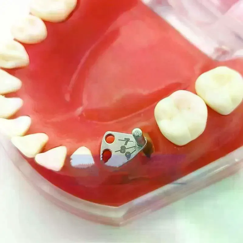 

Зубной имплантат, параллельный штифтовый калибр, медицинский локатор из нержавеющей стали, руководство по установке зубного имплантата, линейка для поиска