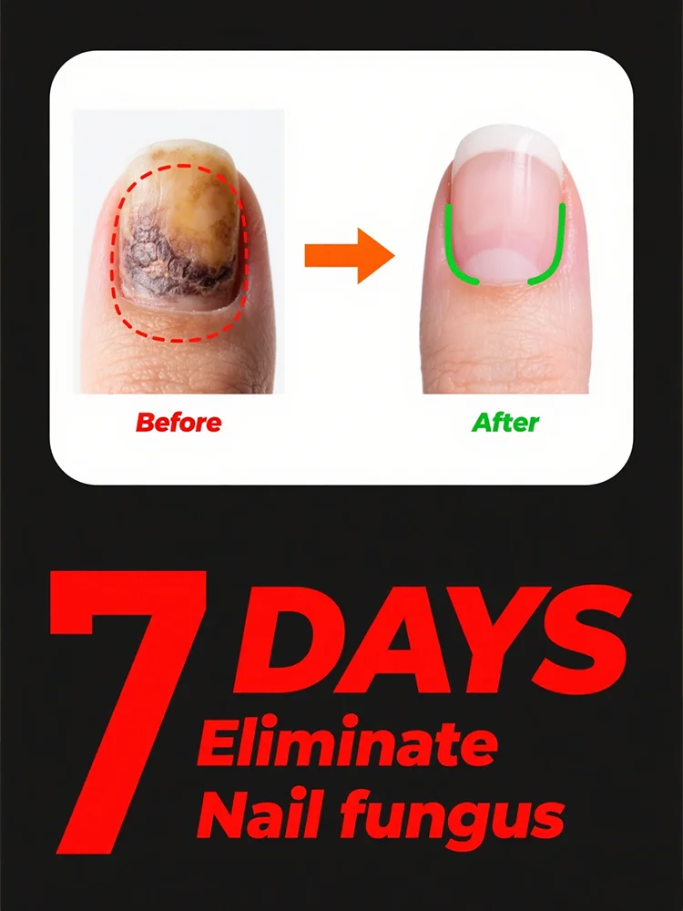 

Quickly eliminate fungus and restore healthy nails