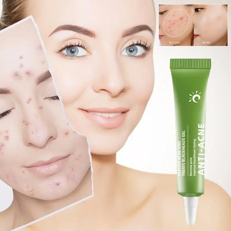 

Acne Removal Cream Freckle Cream Shrink Pores Whitening Moisturizing Oil Control Acne Cream Skin Care Acne Care Face Cream