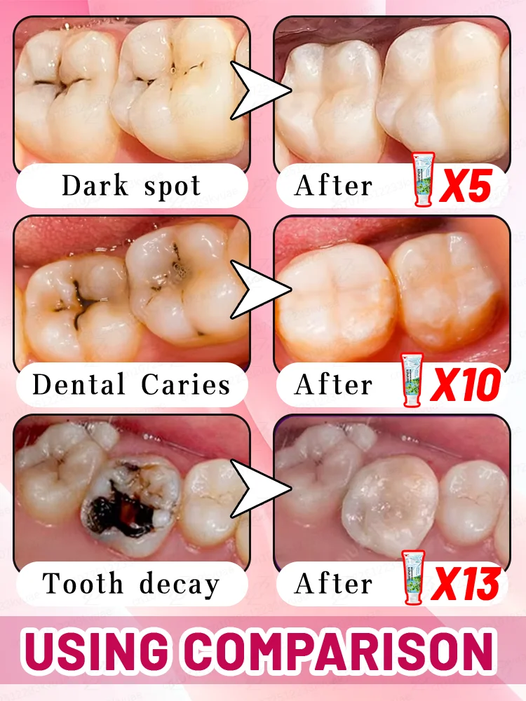 ★ منتج موصى به لطبيب الأسنان ★ معجون أسنان لإزالة البلاك في عيادة الأسنان #6