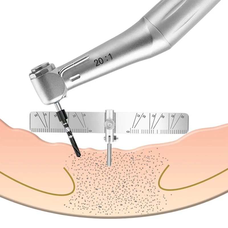 VV-Regla de posicionamiento de implantes dentales, guía de localización de medición ajustable, localizador de plantación quirúrgica, regla de ángulo, herramientas de calibre