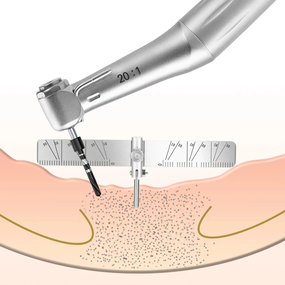 Dental measuring ruler implant positioning ruler oral implant positioning guide plate implant angle ruler with scale dental inst