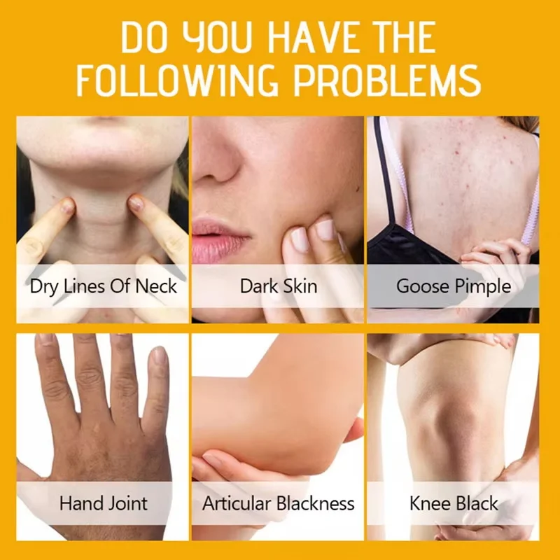 Strong Yellow Peeling Oil Bleach Dark Skin Whiten Lotion Lighten Body Elbow Knee Hand Exfoliate Dead Skin Nourish Even Skin Tone