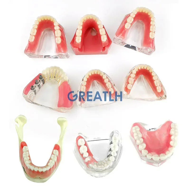 Denti per sovraprotesi dentale modello interno rimovibile mandibolare denti inferiori modello mandibolare con impianto per studio didattico dei denti