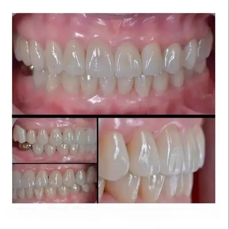 قشور البورسلين للأسنان مادة السيراميك مصممة خصيصًا عملية أسنان إصلاح الضغط الساخن كتل زجاجية من السيراميك المصبوب