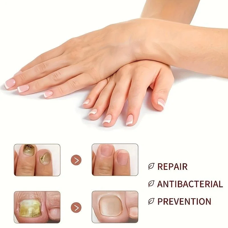 10pcs Ingrown Toenails Band Aid Relief Pain Paronychia Correction Pedicure Elastic Force Sticker Bandage Toe Nail