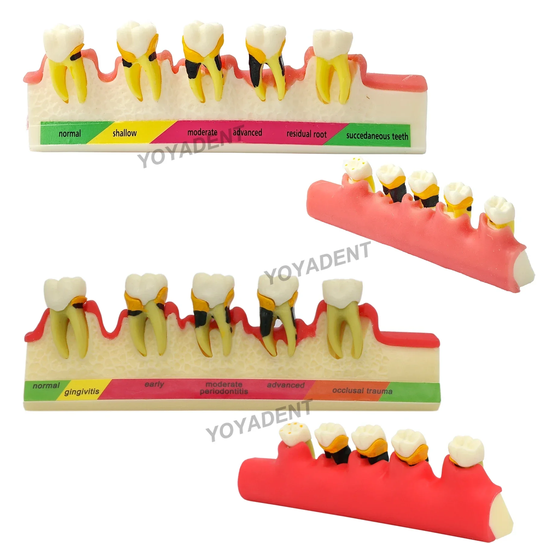 Model zębów Model stomatologii Model nauczania Stomatologiczne choroby przyzębia Patologiczne 5-stopniowa postęp Dentysta Pacjenci Komunikacja