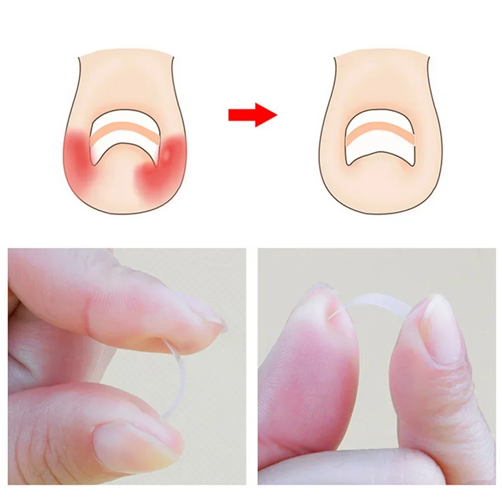 30pcs Ingrown Toe Nail Correction Sticker Patch Paronychia Embed Toe Correction Tool Wire Corrector Foot Care Treatment Tools