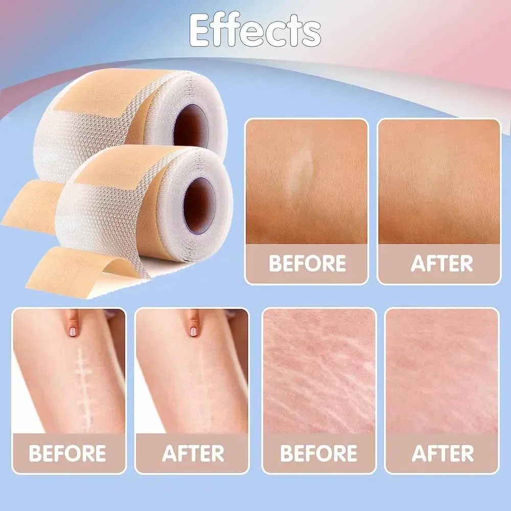 1 Roll Silicone Scars Sheets Keloid Bump Removal Strips,Scars Reducing Treatments Surgical Scars,Burn,Tummy Tucks,Acne,C-Section