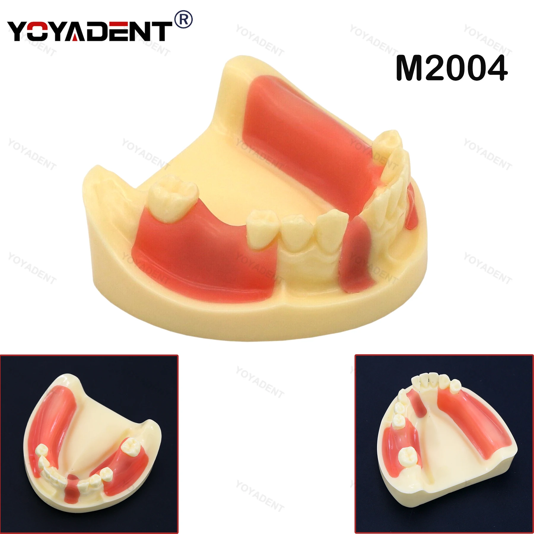 

Dental Implant Model Gingiva Removable Implant Drilling Practice Teeth Model For Patient Education Demo Student Training M2004