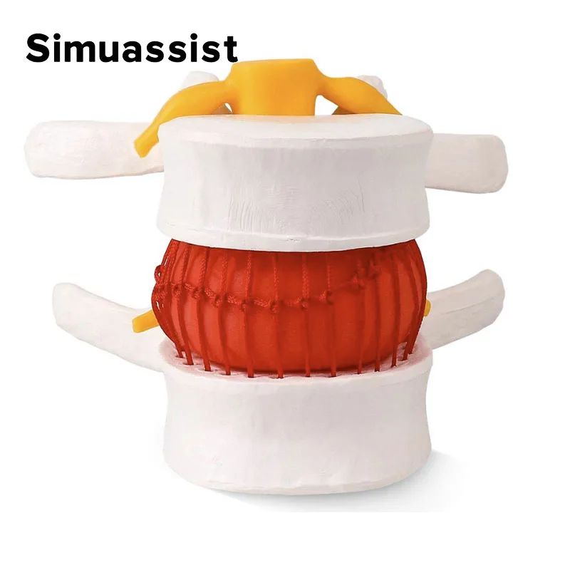 Anatomical Spine Lumbar Disc Herniation Model Medical props model Anatomy Medical Teaching Tool