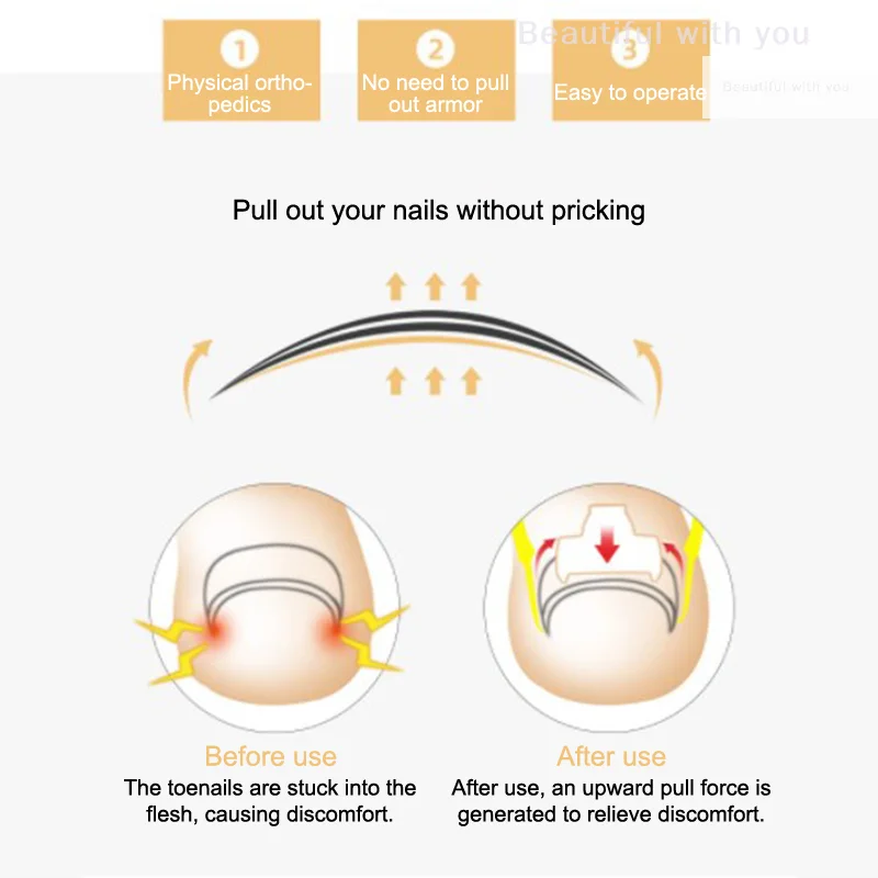 1 Set Toenail Corrector Tools Pedicure Recover Embed Toe Nail Treatment Professional Foot Care Correction Tool