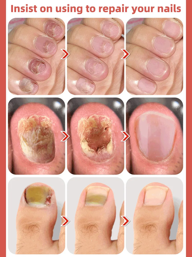 Reducing Infections Fungal Nail R-epair