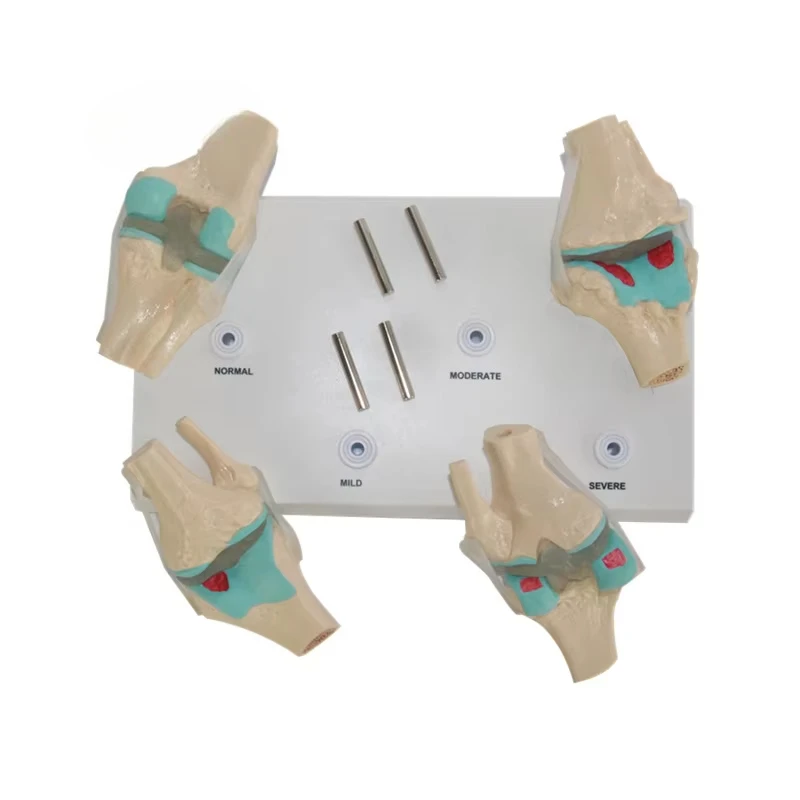 Human Anatomical Joint Disease Model, Stage 4 Pathological Knee Joint Combination Medical Model, Human Knee Joint Model