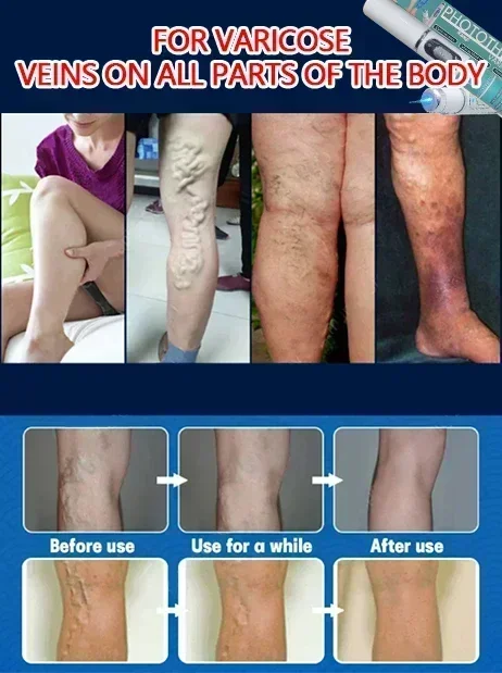 Suporte para circulação para saúde, força e função veia |   para peles sensíveis e couperose |   Ponteiro laser para veias varicosas