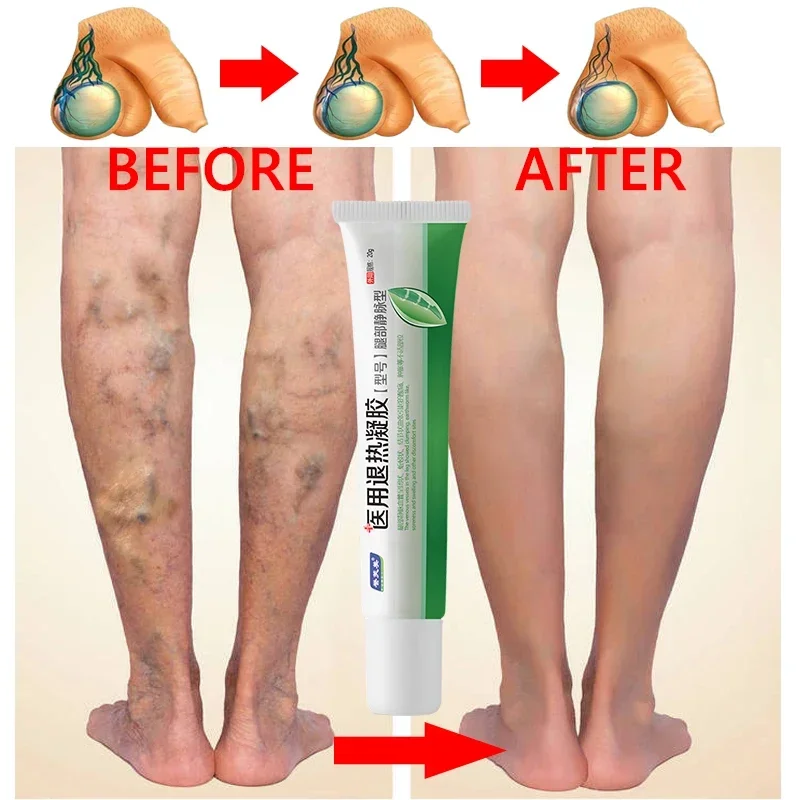 

New Potent Formula Ointment For Varicose Veins Effective Varicose Vein Relief To Relieve Vasculitis Phlebitis Spider Pain