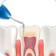 

1 шт., стоматологический наполнитель Gutta Percha Niti, наполнитель для корневых каналов полости рта, эндодонтическая ручная пробка, вертикальное приспособление под давлением, стоматологические инструменты