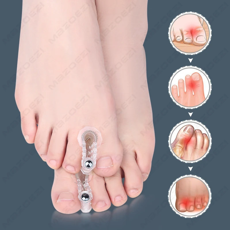 Magnet Orthopedic Big Toe Straightener Hallux Valgus Bunion Corrector Orthotic Feet Bone Thumb Adjuster Correction Pedicure