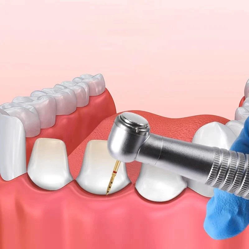 PIORPOY FG7906 الأسنان العمودي الماس FG الأزيز إعداد الأسنان مجموعة ترميم BOPT كامل تاج استعادة أدوات طب الأسنان