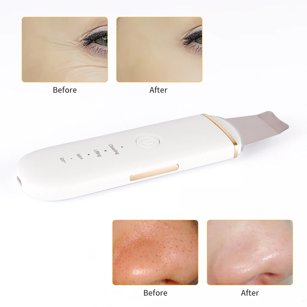 EMS Ultrasonic Skin Scrubber Deep Face Cleansing Machine Peeling Shovel Facial Pore Cleaner Blackhead Removal Lifting Device