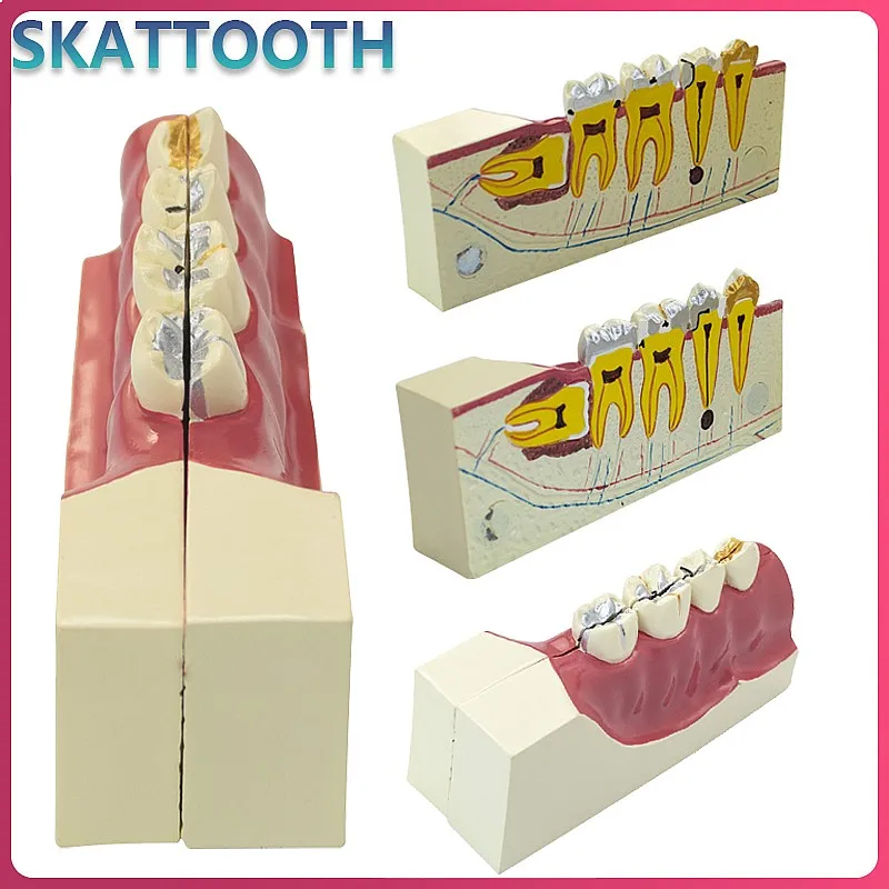 Dentals Simulator Teaching Model Dentist Training Magnet Dentistry Pathological Impacted Tooth Model