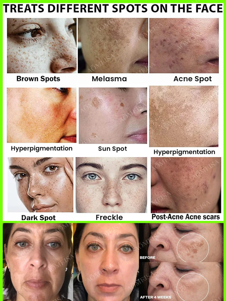 Esencia para eliminar pecas, manchas oscuras, cloasma, pecas, eliminación de manchas pigmentadas de la edad.