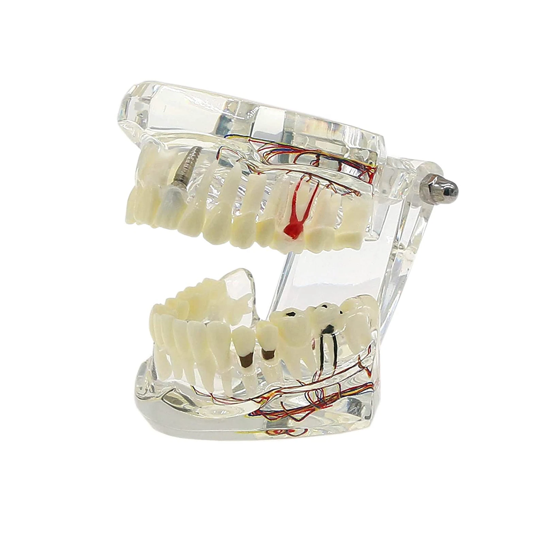 Neural Repair Teeth Model Dental Implant Disease Transparent Standard Adult Pathological Removable Teeth Dentist School Teach