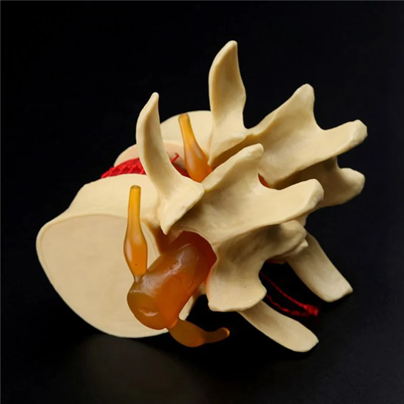 

J1UL1N 3X Lumbar Vertebrae Model Anatomical Spine Lumbar Disc Herniation Anatomy Teaching Tool Lumbar Vertebrae Model