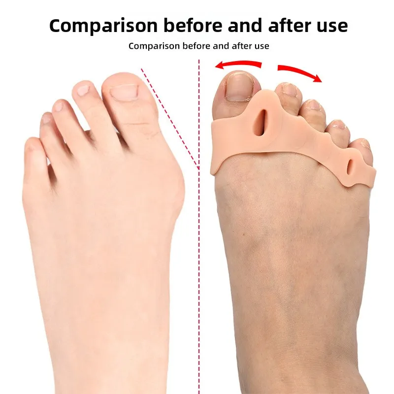 Fünf-Loch-Vorfuß-Bogen-Splitter, Silikon, weiche Unterstützung, sanfte Druckfixierung, Vorfuß-Pad in halber Größe, Hallux-Valgus-Korrektur