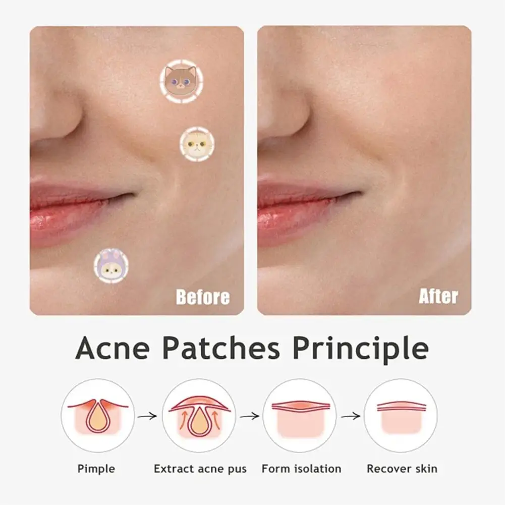 600pcs Color Large Size Acne Patch Concealer Invisible Acne Mark Skin Covering Patch Acne Removal Patch Skin Care