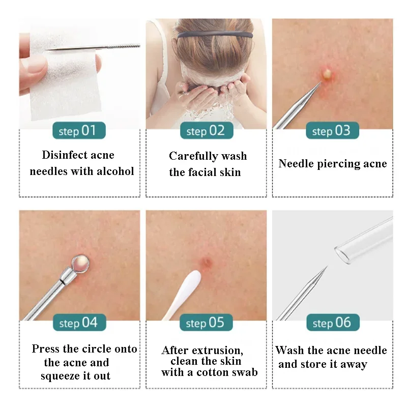 4/5 Stück Mitesser entferner Komedonen Extraktor Akne-Entfernungs-Kit für Makel Whitehead Popping Zit Entfernen für Nase Gesicht Werkzeuge