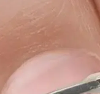 12개입 내성발톱 치료 키트, 4가지 다양한 크기, 티타늄 합금 내성발톱 교정 도구, 곡선형 발톱 교정기