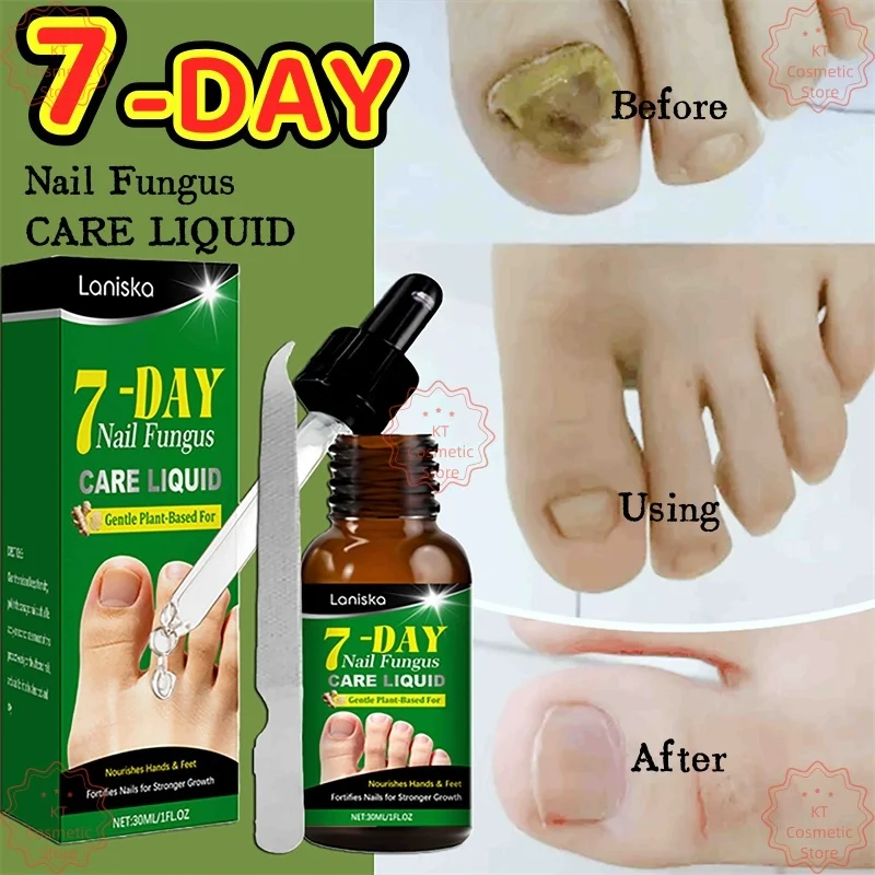 

Nail Fungal Repair Serum Foot Toe Nail Fungus Removal Essential Oil Anti Infection Onychomycosis Paronychia Repairing Care 30ML